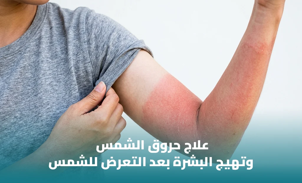 أفضل واقي بعد الشمس لتهدئة البشرة